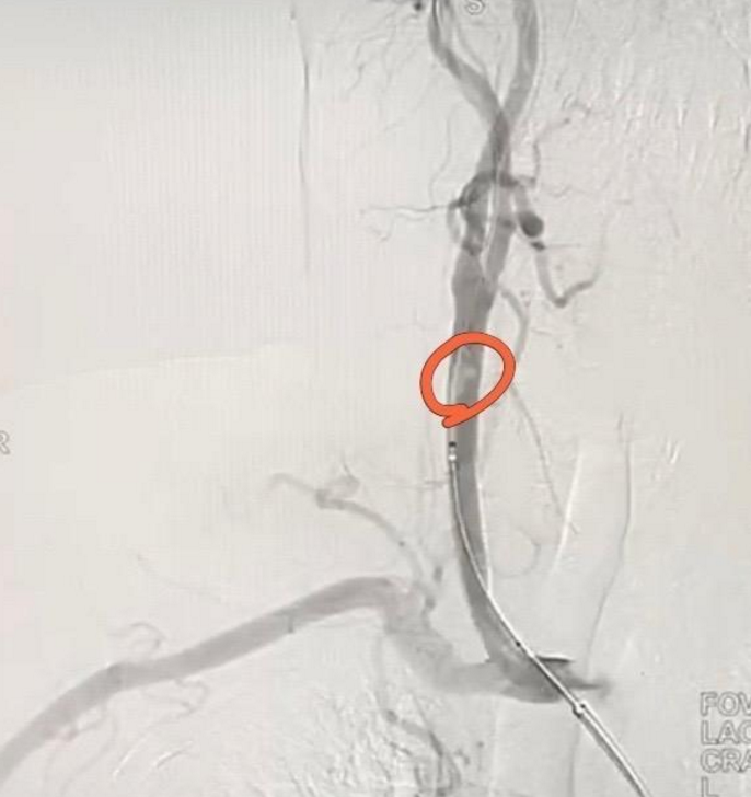 刻不容缓,急行脑血管造影,提示大脑中动脉完全闭塞,一旁待阵的神经