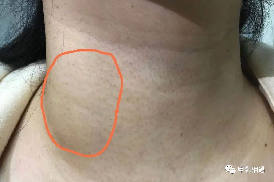 明显肿胀的右侧颈部