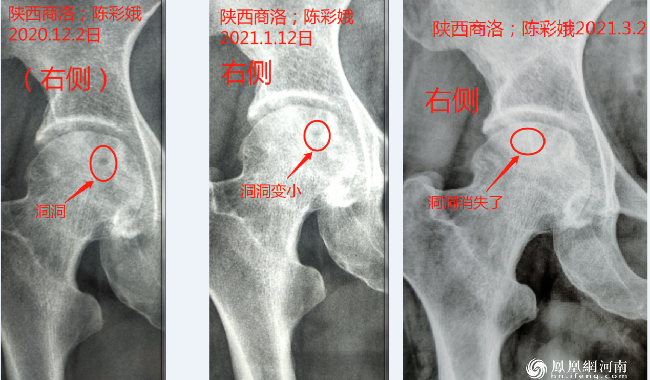 六月寒中医“蒸敷灸”治疗“股骨头坏死”