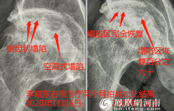 六月寒中医“蒸敷灸”治疗“股骨头坏死”