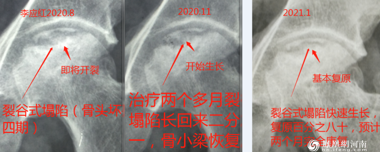 六月寒中医“蒸敷灸”治疗“股骨头坏死”