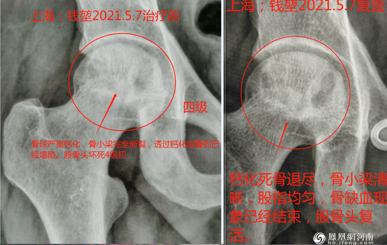 六月寒中医“蒸敷灸”治疗“股骨头坏死”