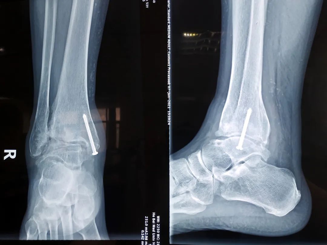 河北医大三院独立完成河北省内首例自主InBoneⅡ假体全踝关节置换术
