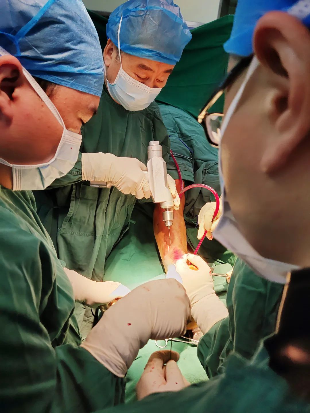 河北医大三院独立完成河北省内首例自主InBoneⅡ假体全踝关节置换术