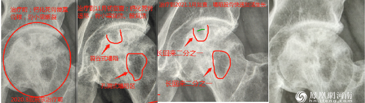 六月寒中医“蒸敷灸”治疗“股骨头坏死”