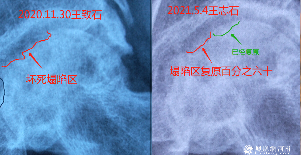 蒸敷灸用实际案例证明坏死股骨可以在生长（至今医学界这样的图片仅存在蒸敷灸技术）