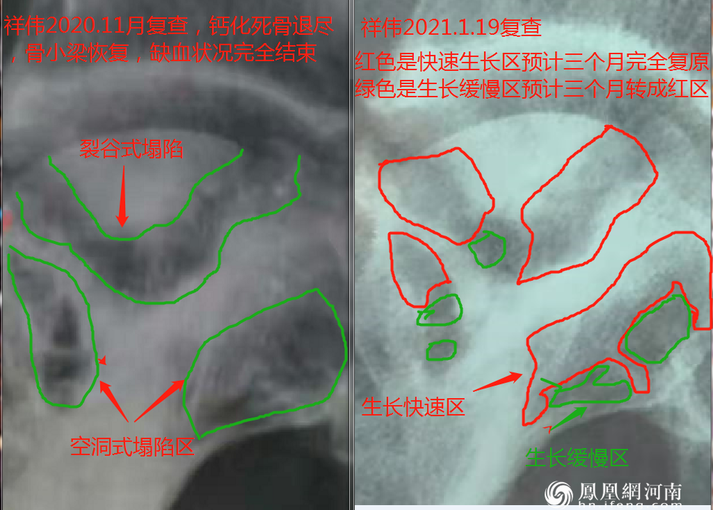 六月寒中医“蒸敷灸”治疗“股骨头坏死”