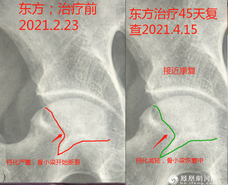 六月寒中医“蒸敷灸”治疗“股骨头坏死”