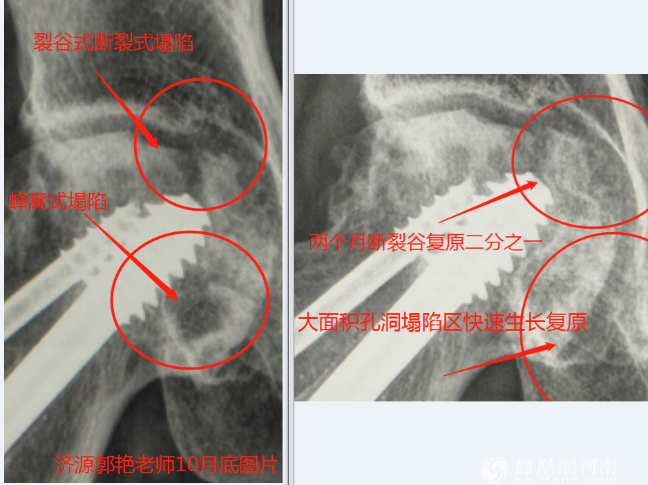 六月寒中医“蒸敷灸”治疗“股骨头坏死”