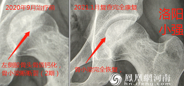 六月寒中医“蒸敷灸”治疗“股骨头坏死”