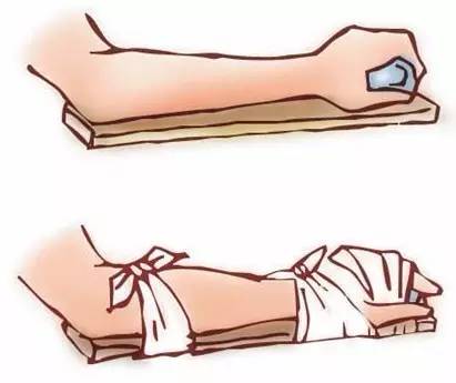 2两白酒下肚长沙53岁阿姨摔得手臂粉碎性骨折