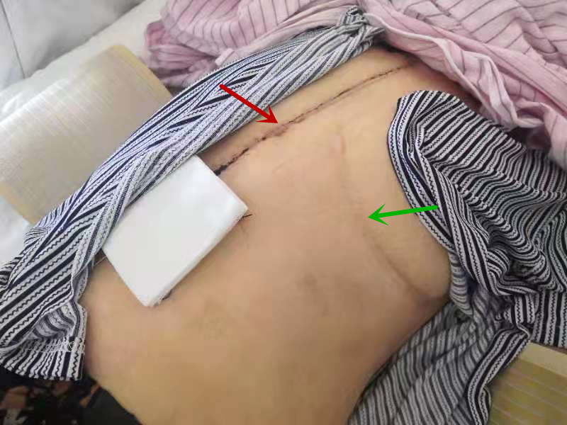 绿色箭头为第一次手术所留疤痕，红色箭头为第二次、第三次手术所留疤痕。为勇敢坚强的吴女士点赞！