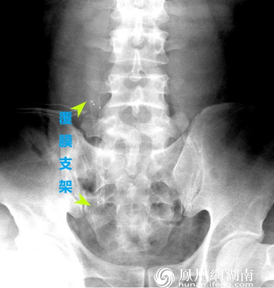 X线摄片显示覆膜金属支架已置入患者右侧输尿管