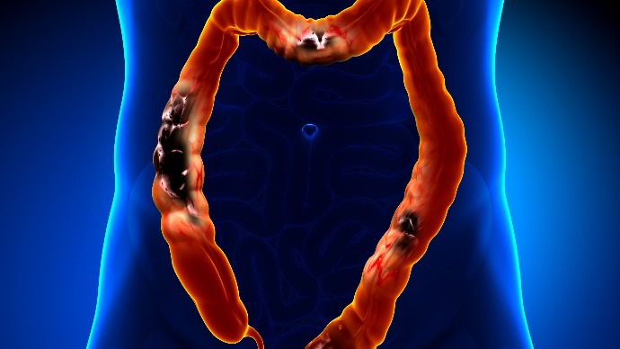 结肠上长息肉易引发癌症，医生提醒：早发现治愈几率大