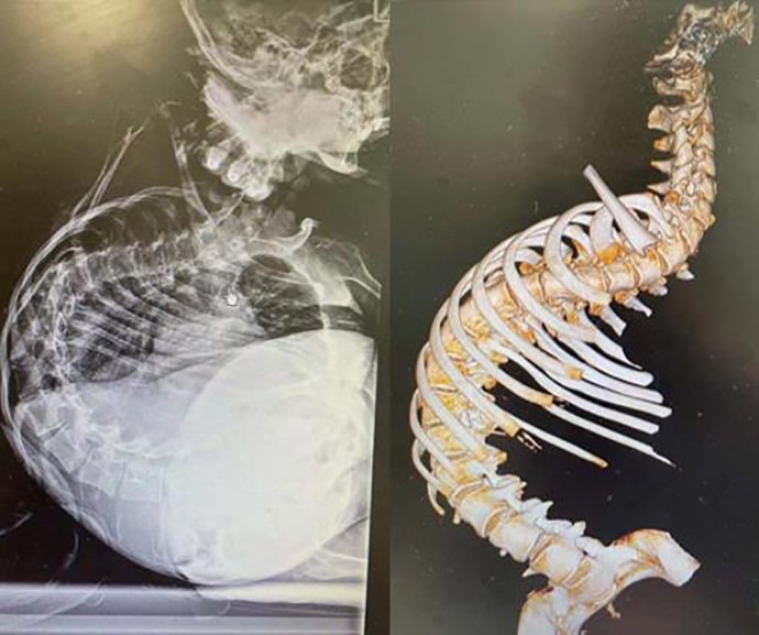 13岁女孩脊柱侧弯176度说话不成句,在上海接受矫治手术