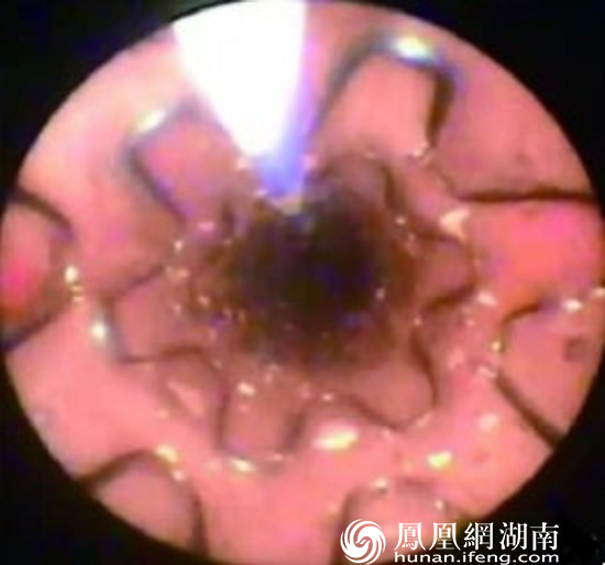 输尿管镜检查显示覆膜金属支架已置入输尿管