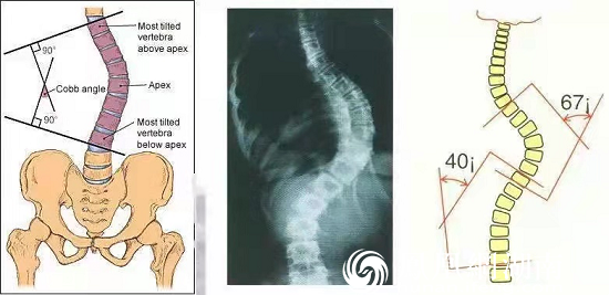 正面x光用於測量科布氏角度(cobb角),當科布氏角度大於10°即存在脊柱