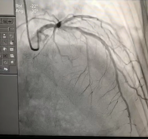 患者冠脉造影图
