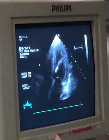 术中超声引导下穿刺