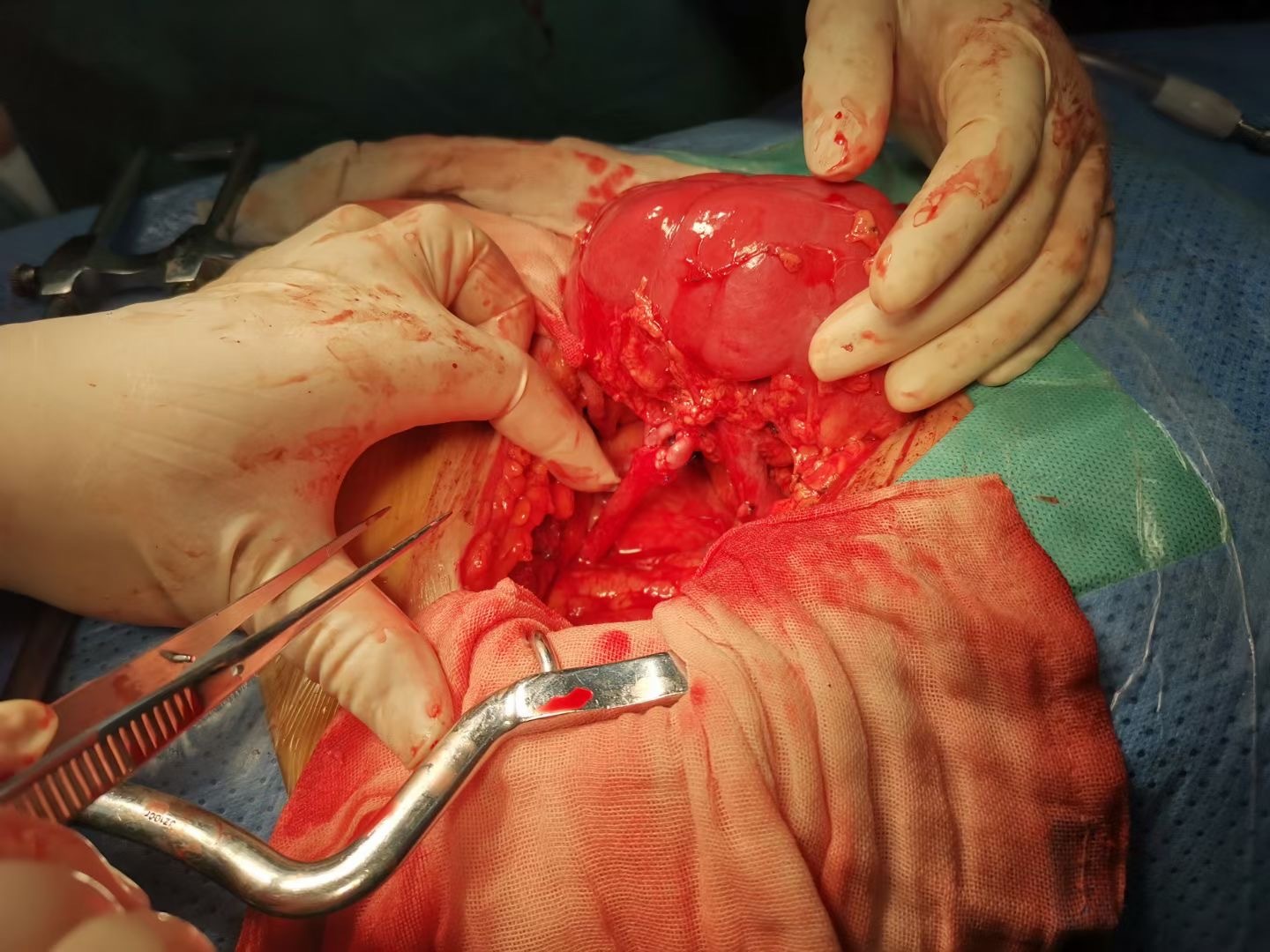 肾移植手术团队创新手术方式福建病友在齐鲁医院完成亲属肾移植