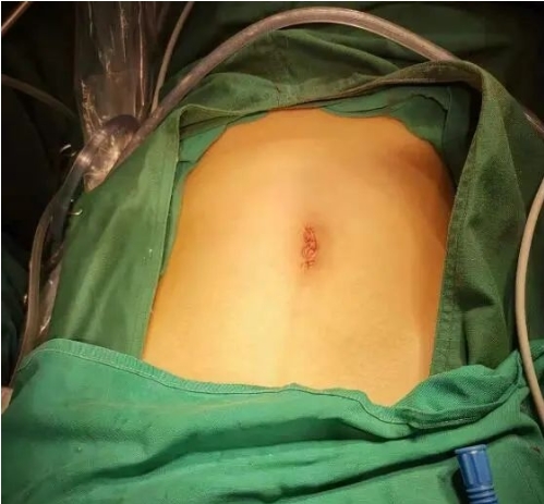 燕达医院妇产科以"无痕"微创技术助孕中期卵巢畸胎瘤患者康复