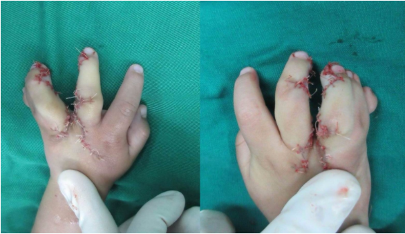 顺德和平医院先天性并指多指畸形典型病例手术实例