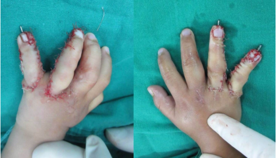小儿麻痹导致手畸形图片