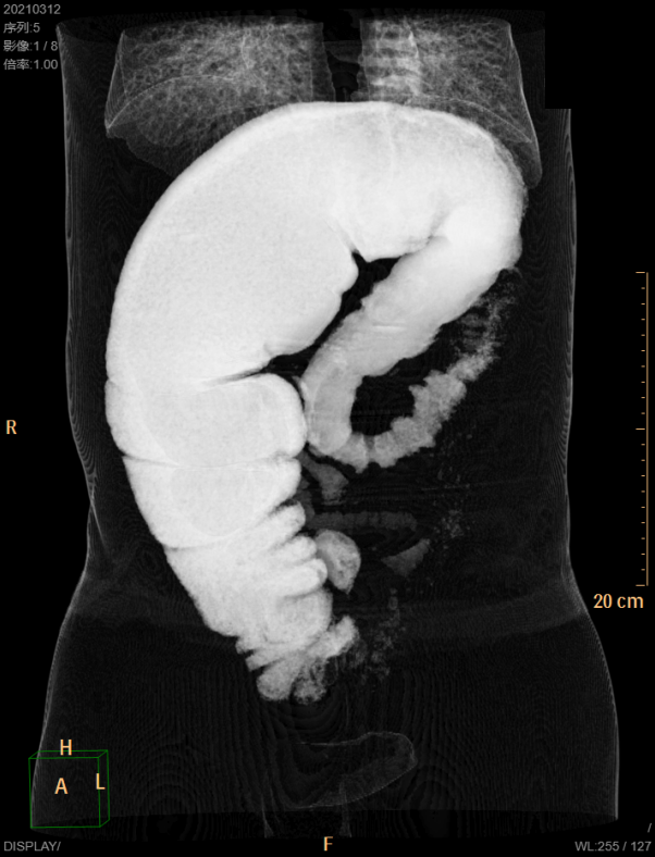 宁波小伙便秘20年的真相 注意了！这种疾病不可忽视