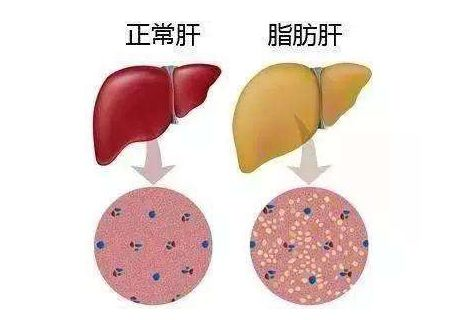 b超脂肪肝图片