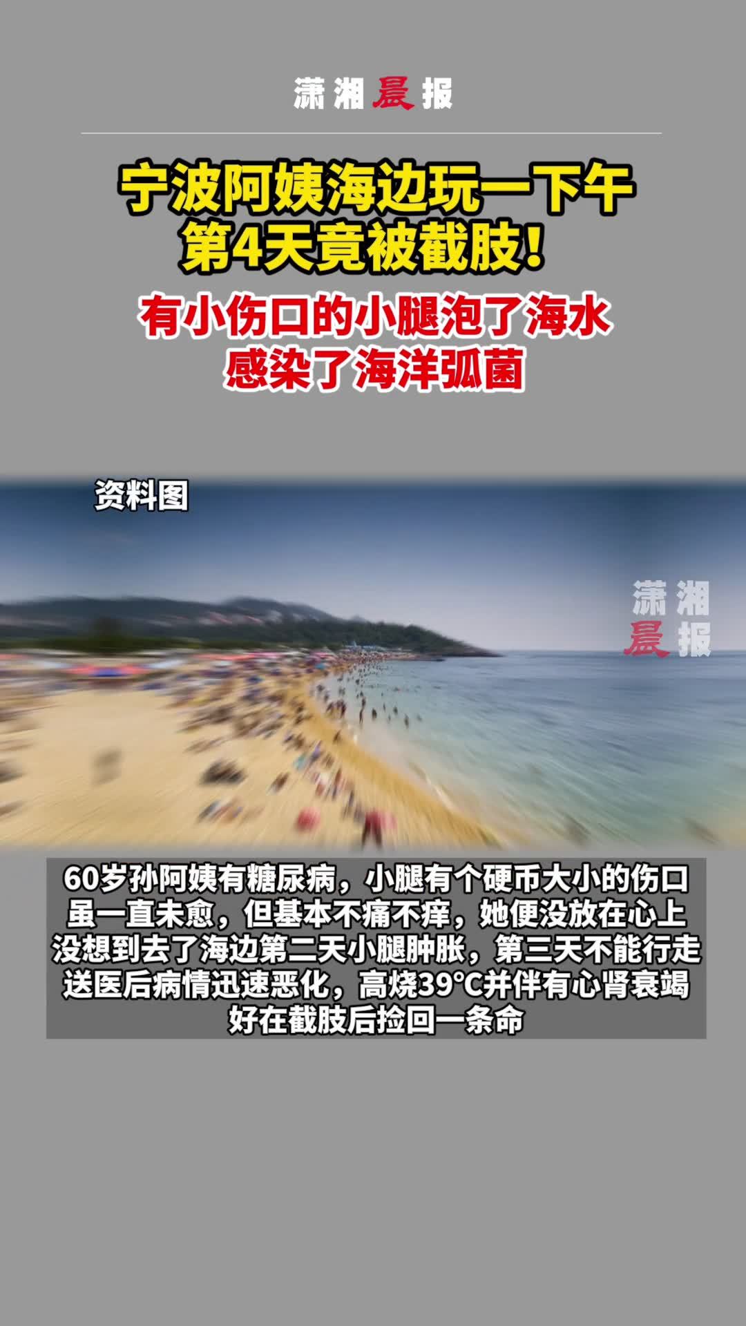 因有小伤口的小腿泡了海水,感染了海洋弧菌