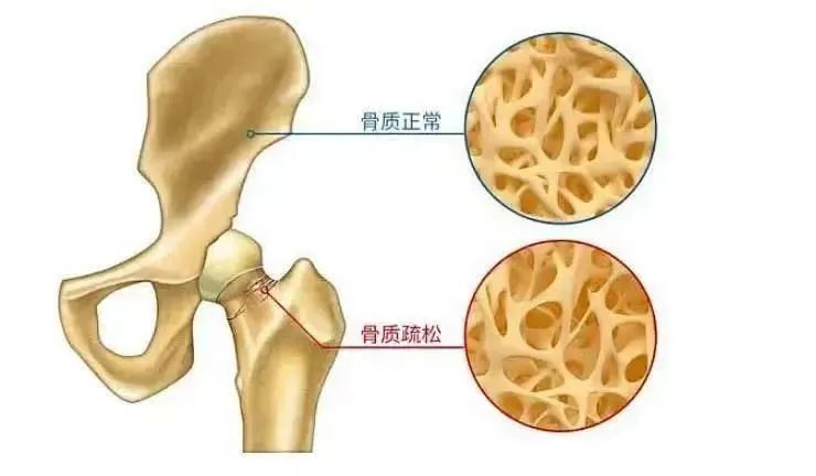 1%;65岁以上人群骨质疏松症患病率高达32%