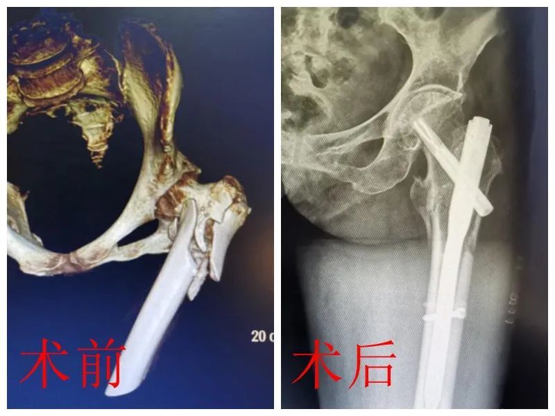 九江市骨科醫院成功完成一例高齡股骨粗隆間骨折pfna內固定術