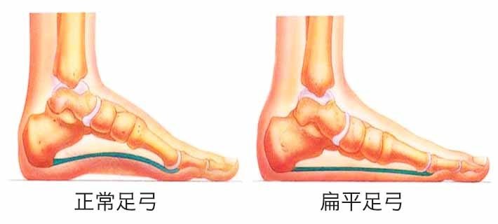 不少家長應該瞭解過,目前針對扁平足比較好的方法是穿矯正鞋矯正,其實