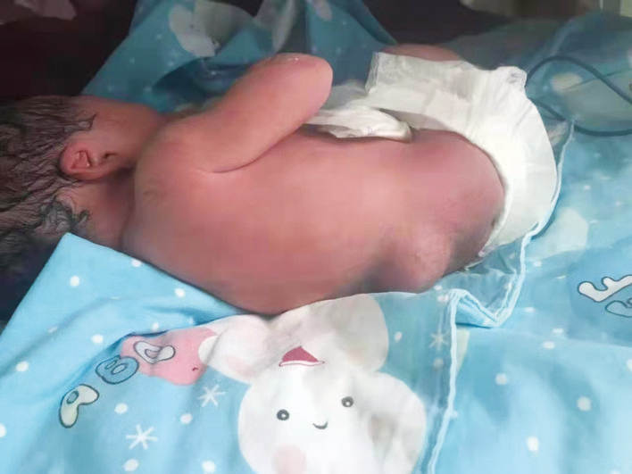 患儿楠楠腰部的包清晰可见。