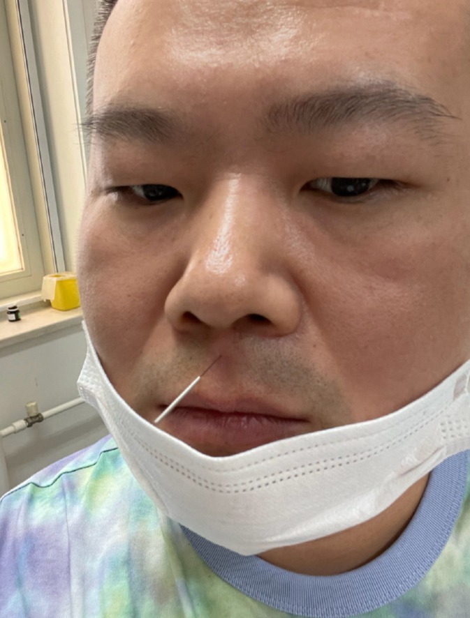 小岳岳扎针灸自拍脸上长针还被医生嘱咐不准笑