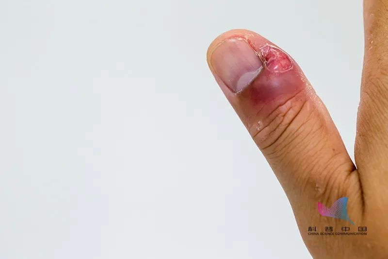自行处理,此外他们往往还会有抠指甲,撕嘴唇死皮,拔头发等强迫性症状