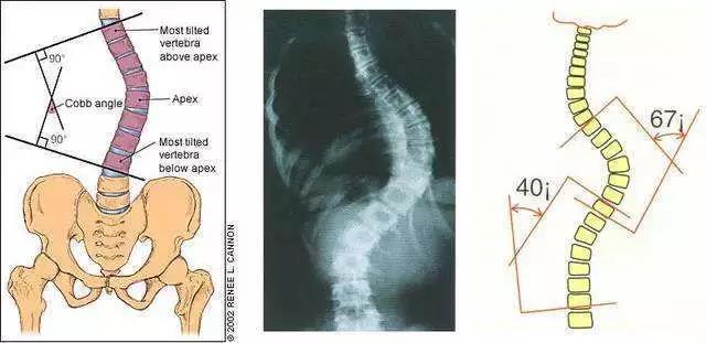 並作這兩條直線的垂線,這兩條垂線相交的夾角,即為該脊柱側彎的cobb角