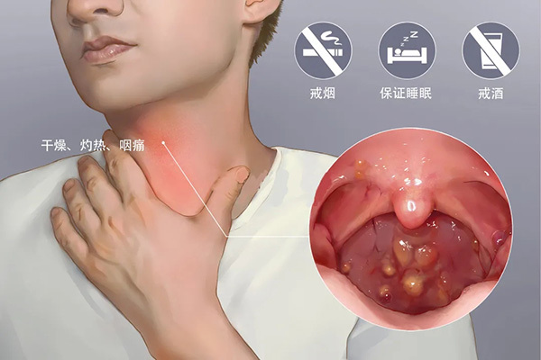 成都民生耳鼻喉医院怎么治声带白斑费用贵不贵