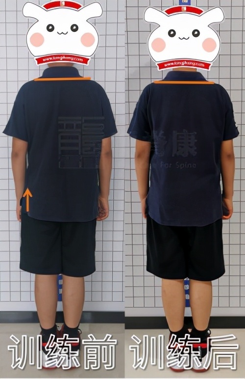 新知达人, 【龙脊康脊柱课堂】小于10度的脊柱侧弯,如何矫正?