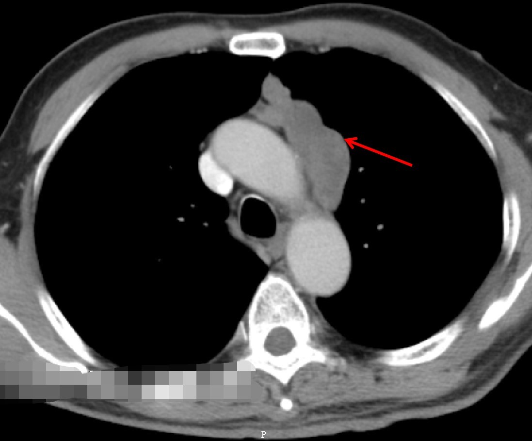 胸部CT发现胸腺瘤