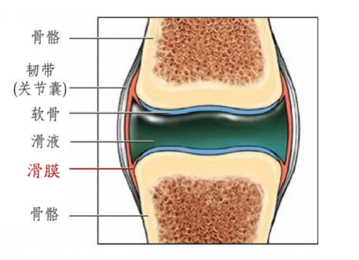 骨关节炎如何治疗