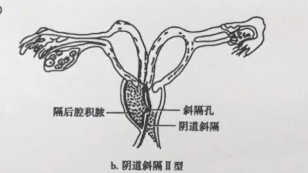 女子每月经期超10天，检查发现双子宫