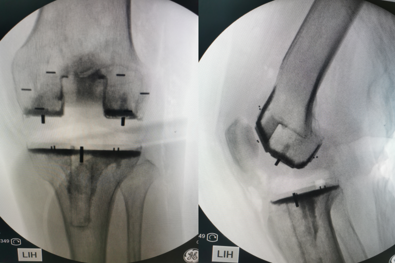 西安市红会医院成功开展西北首例PEEK人工全膝关节置换术