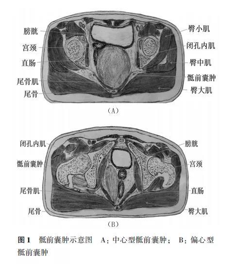 臀裂顶点和尾骨的距离图片