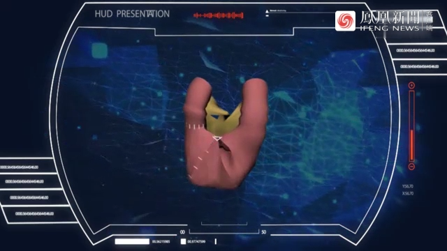 新法治疗膀胱癌术后不再挂尿袋，原位新膀胱手术的过程是什么？