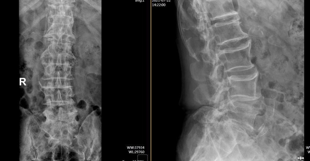 腰椎检查报告单图片图片