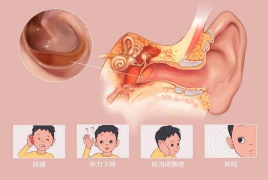中耳积液得不到有效处理会导致中耳听骨链粘连运动受限引起传导性耳聋