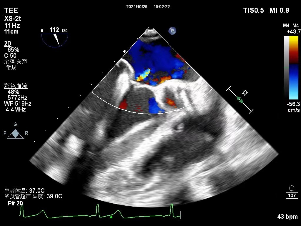 二尖瓣反流(mitral regurgitation,mr)是最常見的心臟瓣膜疾病,以往mr