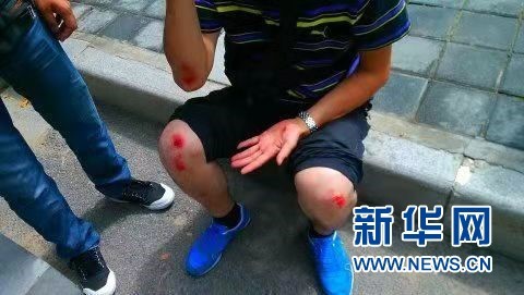2018年，在西安市雁塔区潘家庄，韩红辉参与反扒后受伤。（图片由被采访者提供）