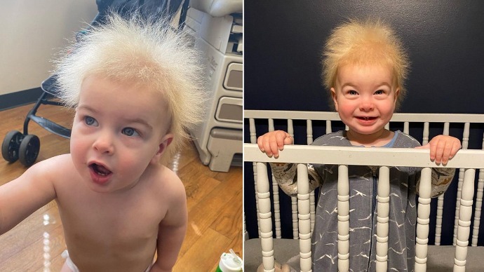 患罕见难梳头发综合征 美国男婴拥有爱因斯坦同款发型